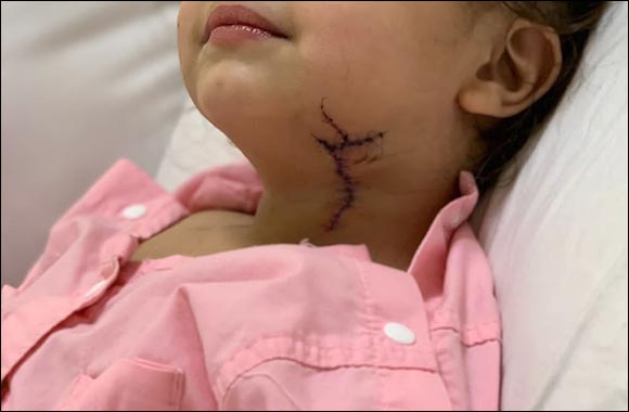 Tabuk Surgeons Save 2-year-old from Fatal Glass Table Wound