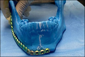 Tabuk Surgeons Reconstruct Jaw with 3D Printing