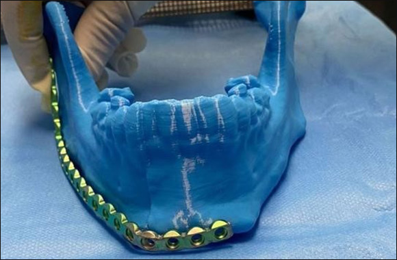 Tabuk Surgeons Reconstruct Jaw with 3D Printing